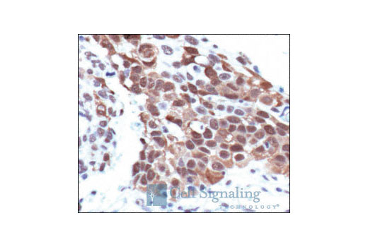 Immunohistochemical analysis of paraffin-embedded human lung carcinoma, using Phospho-PKCdelta/theta (Ser643/676). Antibody.
