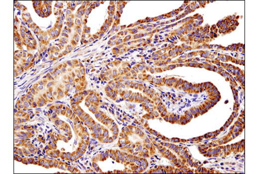 Immunohistochemical analysis of paraffin-embedded human thyroid papillary carcinoma using PLD2 (E1Y9L) Rabbit mAb (IHC Specific).