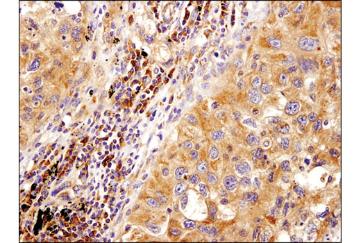 Immunohistochemical analysis of paraffin-embedded human lung non-small cell carcinoma using PLD2 (E1Y9L) Rabbit mAb (IHC Specific).
