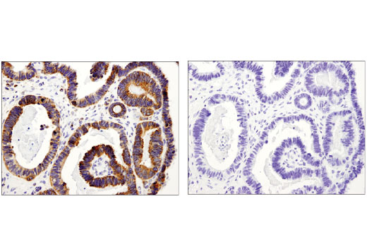 Immunohistochemical analysis of paraffin-embedded human ovarian serous carcinoma using PLD2 (E1Y9L) Rabbit mAb (IHC Specific) in the presence of control peptide (left) or antigen specific peptide (right).