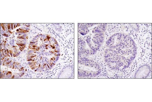 Immunohistochemical analysis of paraffin-embedded human colon carcinoma using PLK1 (208G4) Rabbit mAb in the presence of control peptide (left) or antigen-specific peptide (right).