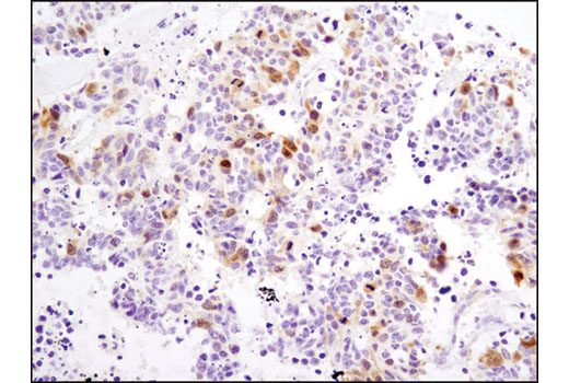 Immunohistochemical analysis of paraffin-embedded human lung carcinoma using PLK1 (208G4) Rabbit mAb.