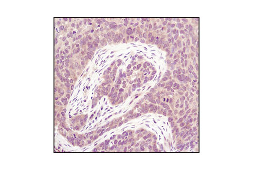 Immunohistochemical analysis of paraffin-embedded human lung carcinoma using PP2A A Subunit (81G5) Rabbit mAb.