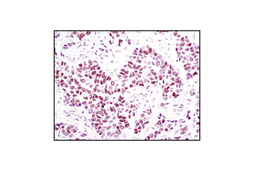 Immunohistochemical analysis of paraffin-embedded human breast carcinoma using Progesterone Receptor A/B (C89F1) Rabbit mAb.