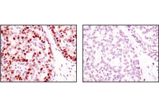 Immunohistochemical analysis of paraffin-embedded human breast carcinoma using Progesterone Receptor A/B (C89F1) Rabbit mAb in the presence of control peptide (left) or antigen-specific peptide (right).