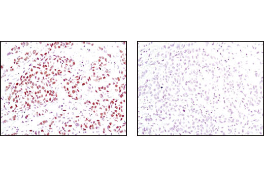 Immunohistochemical analysis of paraffin-embedded human breast carcinoma using Progesterone Receptor B Receptor (C1A2) Rabbit mAb in the presence of control peptide (left) or antigen-specific peptide (right).
