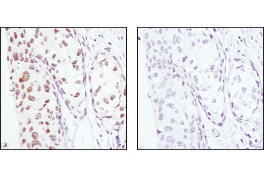 Immunohistochemical analysis of paraffin-embedded human breast carcinoma, using PA28γ Antibody in the presence of control peptide (left) or antigen-specific peptide (right).