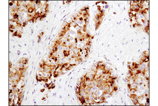 Immunohistochemical analysis of paraffin-embedded breast carcinoma using RAIG1 (D4S7D) XP ® Rabbit mAb.