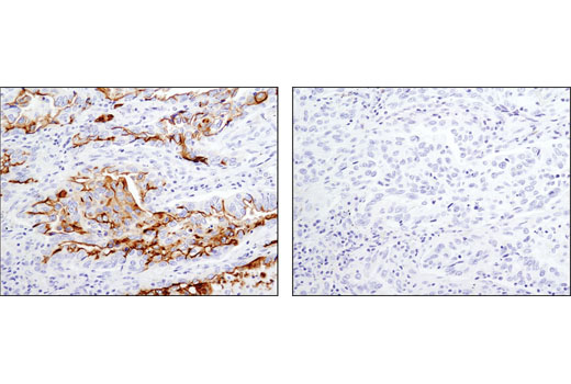 Immunohistochemical analysis of paraffin-embedded human lung carcinoma using RAIG1 (D4S7D) XP ® Rabbit mAb in the presence of control peptide (left) or antigen-specific peptide (right).