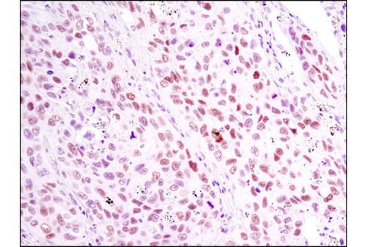 Immunohistochemical analysis of paraffin-embedded human lung carcinoma using RARγ1 (D3A4) XP ® Rabbit mAb.