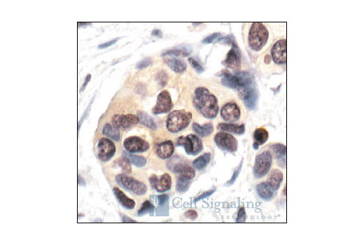 Immunohistochemical analysis of paraffin-embedded breast carcinoma showing nuclear and cytoplasmic ubiquitin localization, using Ubiquitin (P4D1) Mouse mAb.