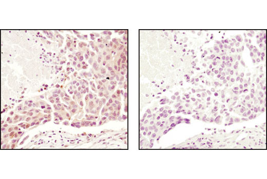 Immunohistochemical analysis of paraffin-embedded human breast carcinoma using Ubiquitin Antibody in the presence of control peptide (left) or antigen-specific peptide (right).