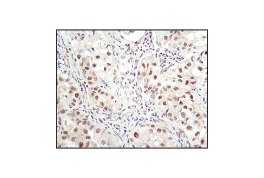 Immunohistochemical analysis of paraffin-embedded human lung carcinoma using Ubiquitin Antibody.