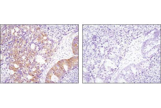 Immunohistochemical analysis of paraffin-embedded human ovarian carcinoma, control (left) or λ phosphatase-treated (right), using Phospho-p90RSK (Thr359) (D1E9) Rabbit mAb.