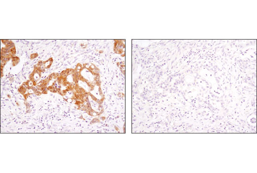 Immunohistochemical analysis of paraffin-embedded colon carcinoma using Phospho-p90RSK (Thr359) (D1E9) Rabbit mAb in the presence of control peptide (left) or antigen-specific peptide (right).