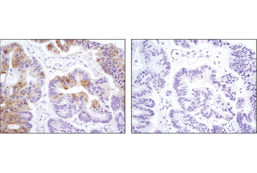 Immunohistochemical analysis of paraffin-embedded human colon carcinoma, control (left) or λ phosphatase-treated (right), using Phospho-p90RSK (Ser380) (D3H11) Rabbit mAb.