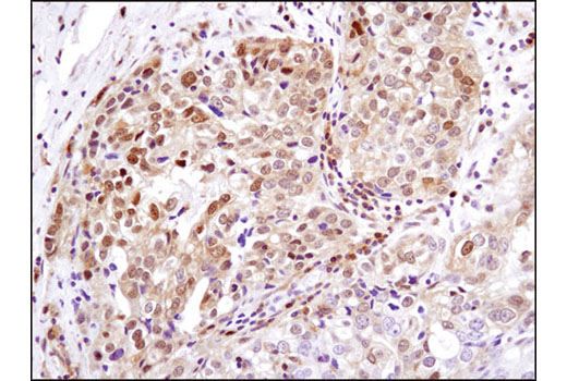 Immunohistochemical analysis of paraffin-embedded human ovarian carcinoma using Phospho-p90RSK (Ser380) (D3H11) Rabbit mAb.
