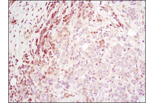 Immunohistochemical analysis of paraffin-embedded human breast carcinoma using RSK2 (D21B2) XP ® Rabbit mAb.