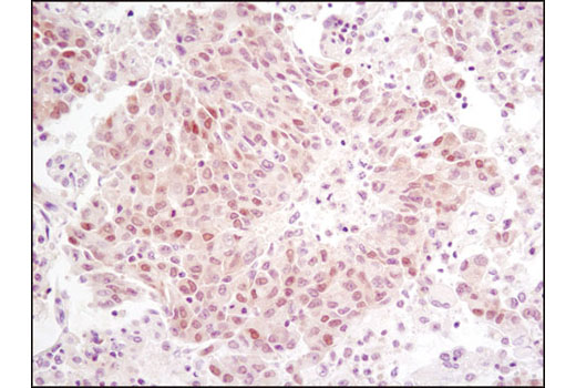 Immunohistochemical analysis of paraffin-embedded human lung carcinoma using RSK2 (D21B2) XP ® Rabbit mAb.