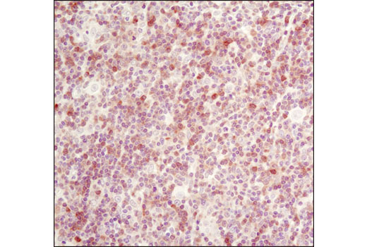 Immunohistochemical analysis of paraffin-embedded human lymphoma using RSK2 (D21B2) XP ® Rabbit mAb.