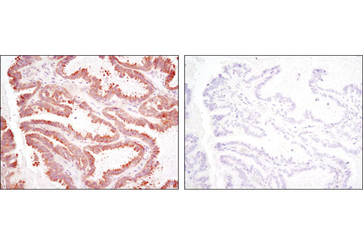 Immunohistochemical analysis of paraffin-embedded human ovarian serous adenocarcinoma using RSK2 (D21B2) XP ® Rabbit mAb in the presence of control peptide (left) or antigen-specific peptide (right).
