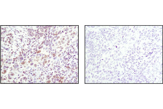 Immunohistochemical analysis of paraffin-embedded human lung carcinoma using Phospho-SAPK/JNK (Thr183/Tyr185) (81E11) Rabbit mAb in the presence of control peptide (left) or Phospho-SAPK/JNK (Thr183/Tyr185) Blocking Peptide #1215 (right).