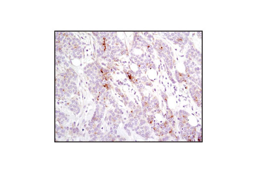 Immunohistochemical analysis of paraffin-embedded human breast carcinoma using SCF (C19H6) RmAb.