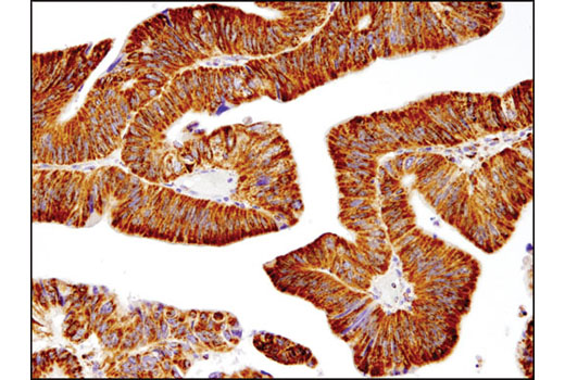 Immunohistochemical analysis of paraffin-embedded human colon adenocarcinoma using SOD2 (D3X8F) XP ® Rabbit mAb.