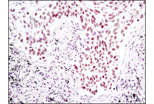 Immunohistochemical analysis of paraffin-embedded human lung carcinoma using SP1 (D4C3) Rabbit mAb.
