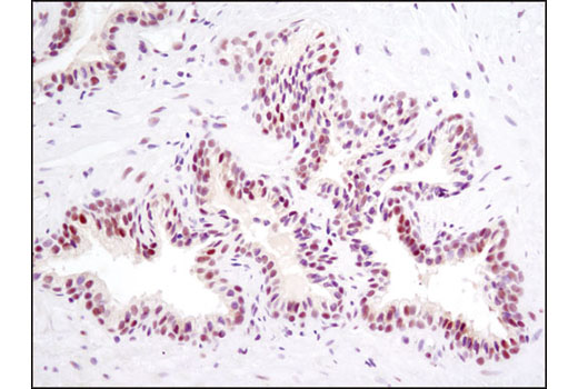Immunohistochemical analysis of paraffin-embedded human prostate carcinoma using SP1 (D4C3) Rabbit mAb.