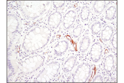 Immunohistochemical analysis of paraffin-embedded human colon carcinoma using SPARC (D10F10) Rabbit mAb.