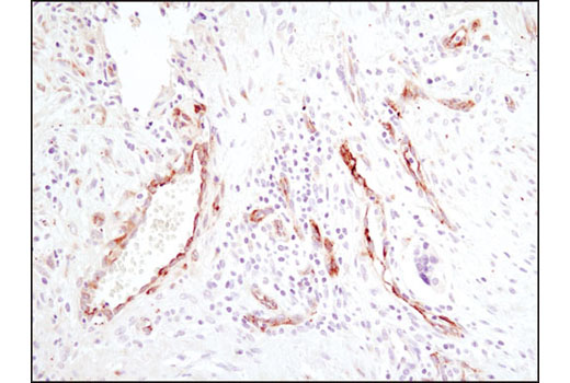 Immunohistochemical analysis of paraffin-embedded human lung carcinoma using SPARC (D10F10) Rabbit mAb.