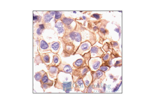 Immunohistochemical analysis of paraffin-embedded human breast carcinoma, showing membrane and cytoplasmic localization using Phospho-Src (Tyr527) Antibody.