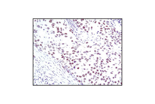 Immunohistochemical analysis of paraffin-embedded human breast carcinoma using SRC-1 (128E7) Rabbit mAb.