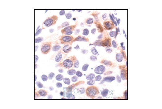 Immunohistochemical analysis of paraffin-embedded human breast carcinoma, showing cytoplasmic localization, using Stathmin Antibody.