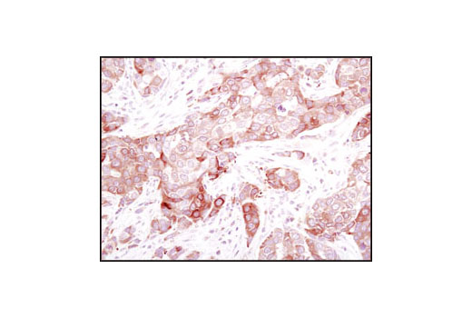Immunohistochemical analysis of paraffin-embedded human breast carcinoma using Stathmin Antibody.
