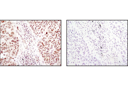 Immunohistochemical analysis of paraffin-embedded human lung carcinoma using SUMO-1 (C9H1) Rabbit mAb in the presence of control peptide (left) or antigen specific peptide (right).