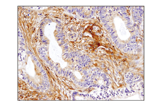 Immunohistochemical analysis of paraffin-embedded human colon carcinoma using Talin-1 (C45F1) Rabbit mAb.