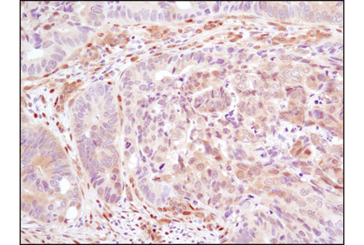 Immunohistochemical analysis of paraffin-embedded human colon carcinoma using YAP/TAZ (D24E4) Rabbit mAb.