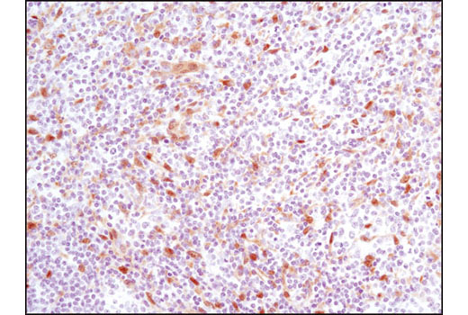 Immunohistochemical analysis of paraffin-embedded human lymphoma using YAP/TAZ (D24E4) Rabbit mAb.