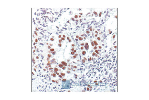 Immunohistochemical analysis of paraffin-embedded human lung carcinoma, using TFII-I Antibody.