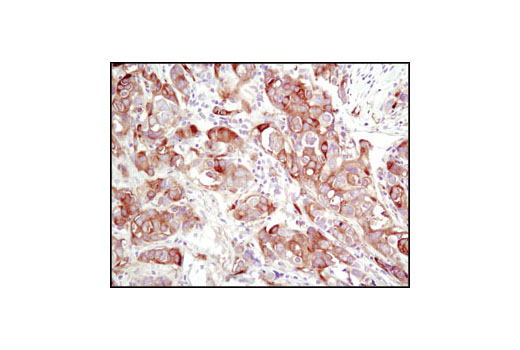 Immunohistochemical analysis of paraffin-embedded human breast carcinoma using TGM2 (D11A6) XP ® Rabbit mAb.