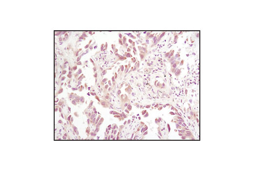 Immunohistochemical analysis of paraffin-embedded human lung carcinoma using Thioredoxin 1 (C63C6) Rabbit mAb.
