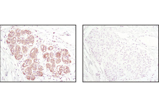 Immunohistochemical analysis of paraffin-embedded human breast carcinoma using Thioredoxin 1 (C63C6) Rabbit mAb in the presence of control peptide (left) or Thioredoxin Blocking Peptide #1057 (right).