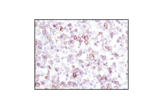Immunohistochemical analysis of paraffin-embedded human Non-Hodgkin's lymphoma, using Phospho-Ezrin (Thr567)/Radixin (Thr564)/ Moesin (Thr558) (41A3) Rabbit mAb