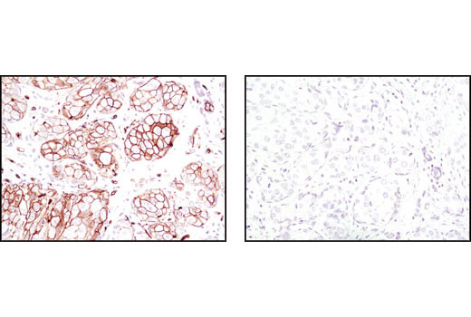 Immunohistochemical analysis of paraffin-embedded human breast carcinoma using Phospho-Ezrin (Thr567)/Radixin (Thr564)/Moesin (Thr558) (41A3) Rabbit mAb #3149 in the presence of control peptide (left) or Phospho-Ezrin (Thr567)/Radixin (Thr564)/Moesin (Thr558) (41A3) Blocking Peptide (right).