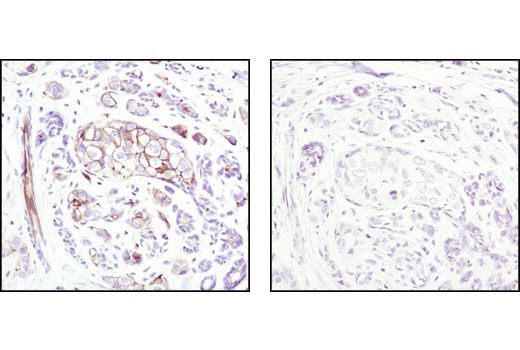Immunohistochemical analysis of paraffin-embedded human breast carcinoma, using Phospho-Ezrin (Thr567)/Radixin (Thr564)/ Moesin (Thr558) (41A3) Rabbit mAb in the presence of control peptide (left) or Phospho-Ezrin (Thr567)/Radixin (Thr564)/ Moesin (Thr558) Blocking Peptide #1047 (right).