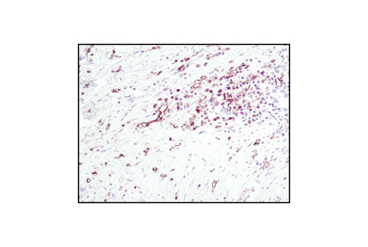 Immunohistochemical analysis of paraffin-embedded human stomach carcinoma, using Phospho-Ezrin (Thr567)/Radixin (Thr564)/ Moesin (Thr558) (41A3) Rabbit mAb.