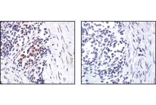 Immunohistochemical analysis of paraffin-embedded human lung carcinoma, untreated (left) or lambda phosphatase-treated (right), using Phospho-TLK1 (Ser743) Antibody.