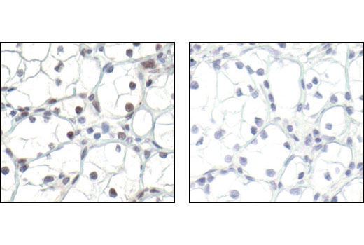 Immunohistochemical analysis of paraffin-embedded human renal cell carcinoma, using Phospho-TLK1 (Ser743) Antibody in the presence of control peptide (left) or antigen-specific peptide (right).